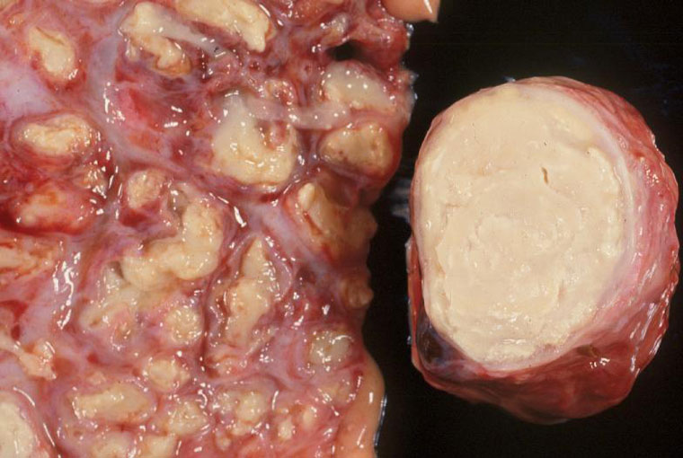 Patologiska bölder i lunga och lumfknuta